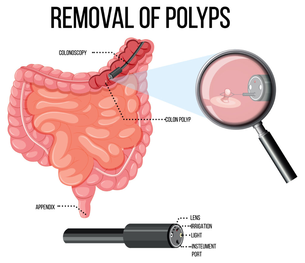 Colonic polyp removal method and tools