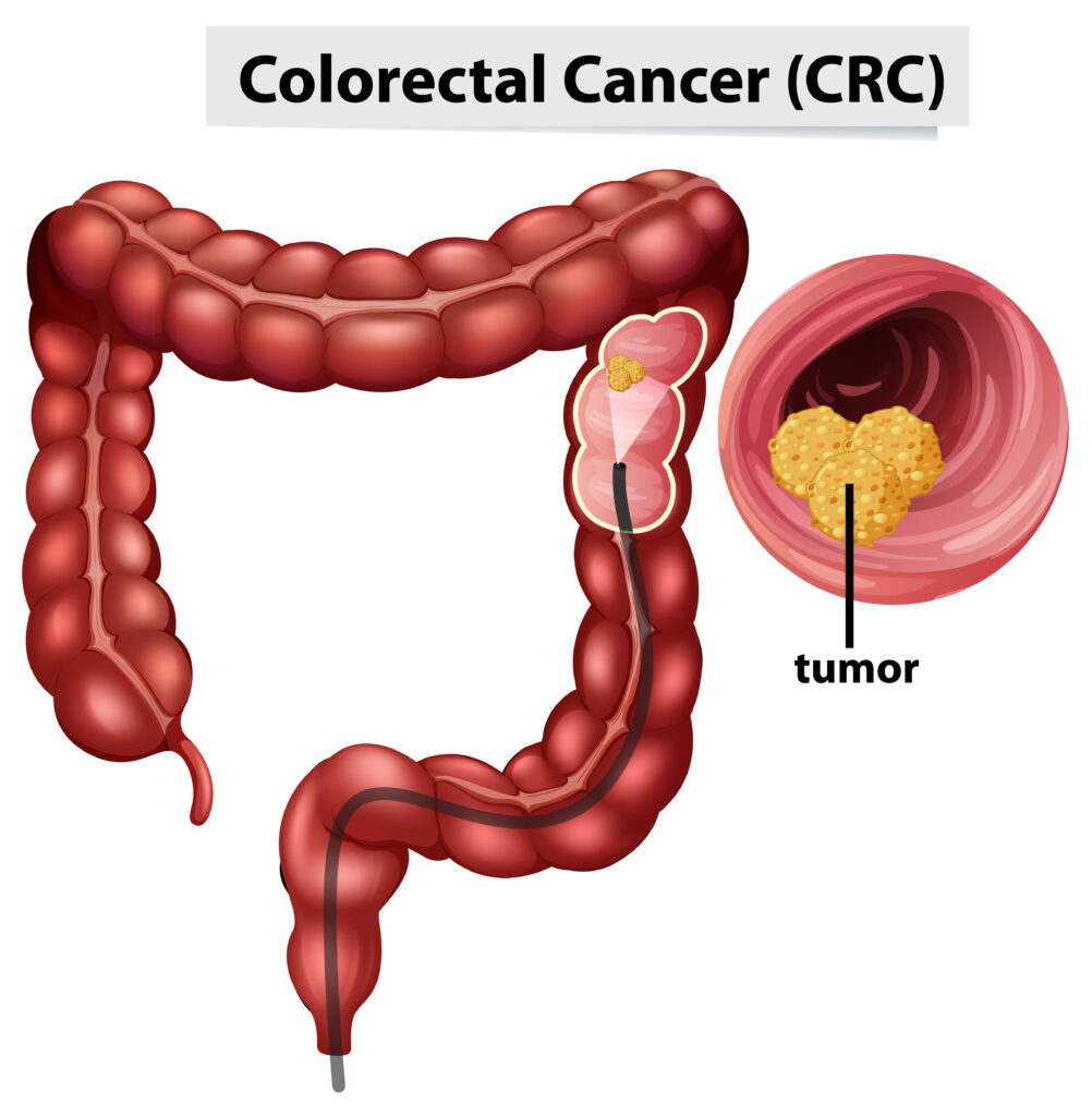 colonic cancer