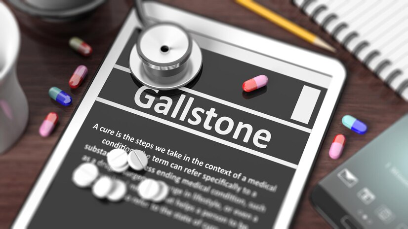 All You Need to Know About Gallstone Disease