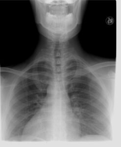 Example for chest x-ray